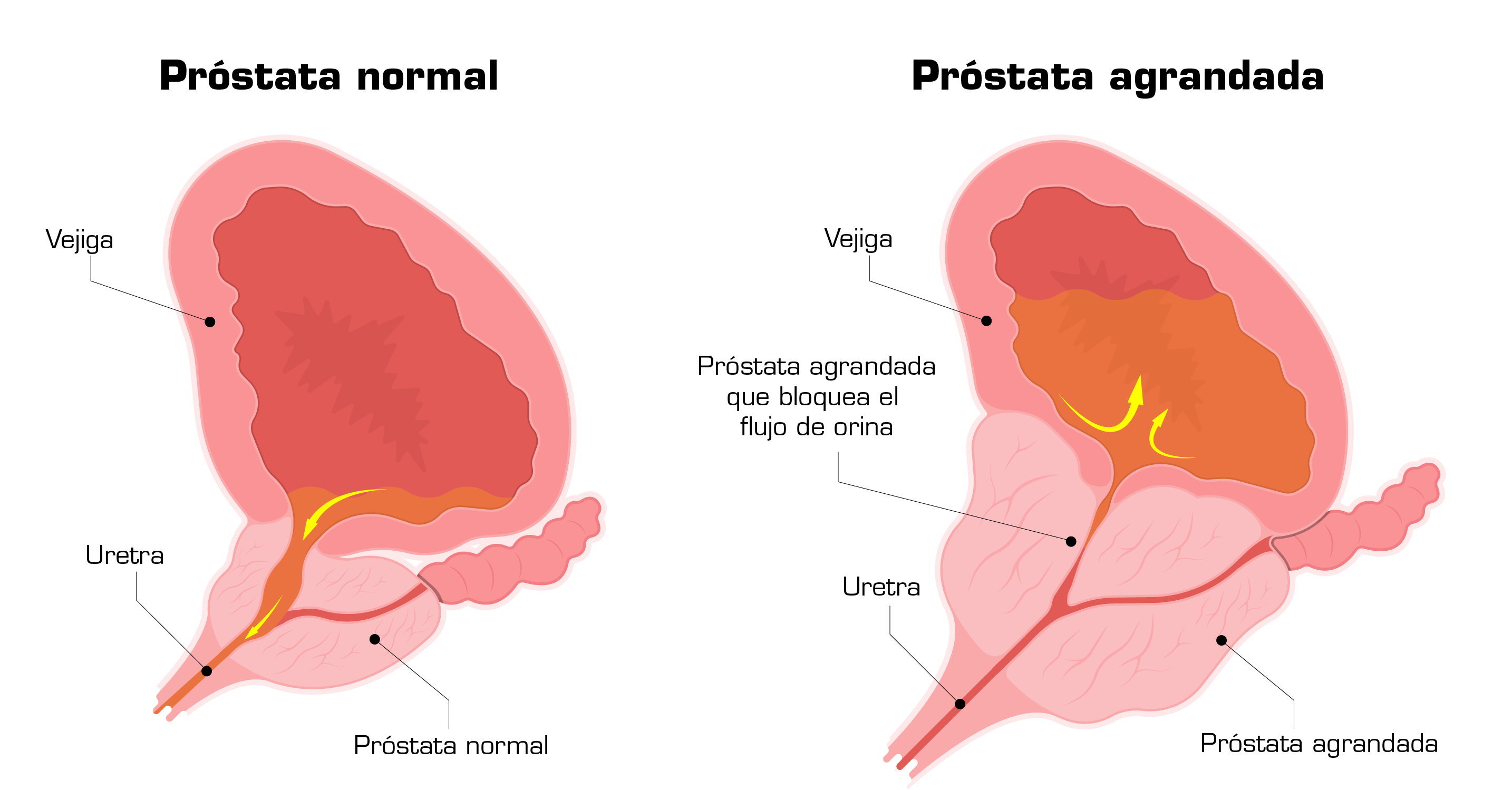 normal vs enlarged prostate